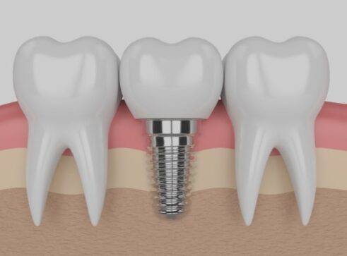 Teeth in a Day Leicester - Treatment - Aesthetic Smiles Dental