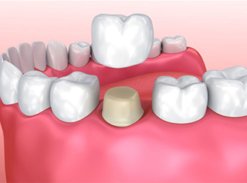 Dental Crowns Leicester - Treatment - Aesthetic Smiles Dental